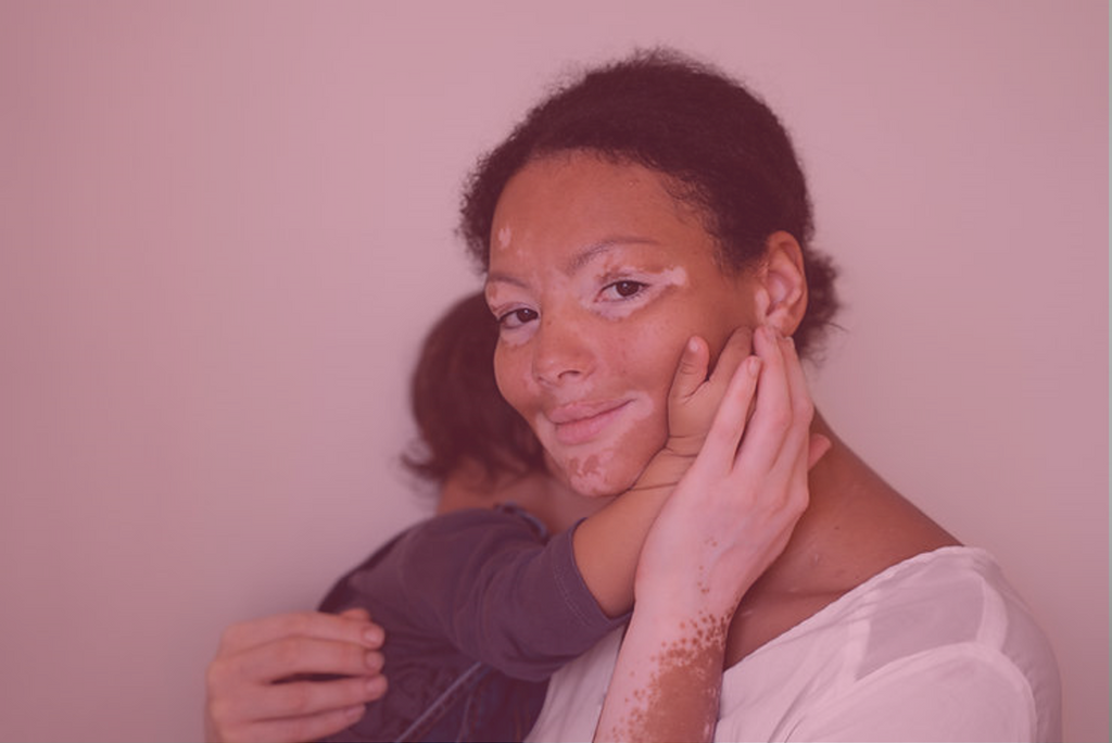 Risco Genético para Vitiligo: Estratégias de Prevenção através do Conhecimento Aprofundado